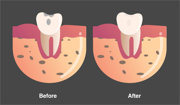 Fillings