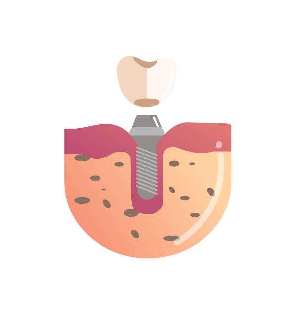 Dental Implant