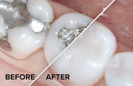 Before and after mercury free fillings